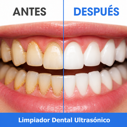 Removedor Sarro Dental Electrico